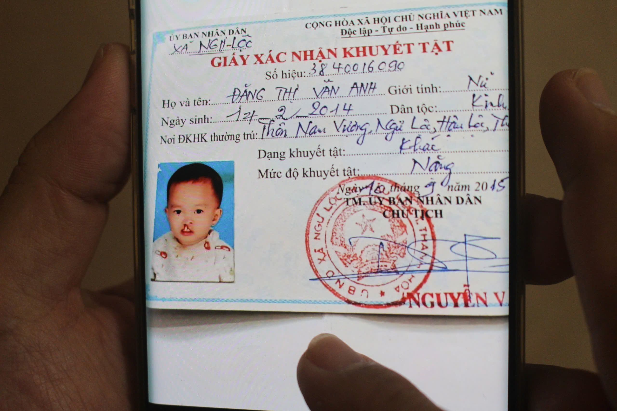 Bé Vân Anh khi chưa được phẫu thuật sứt môi, hở hàm ếch (Ảnh: Hạnh Linh).